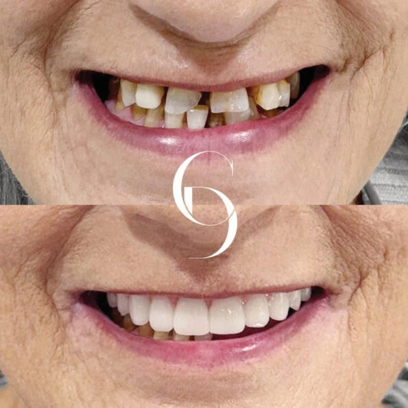 All Teeth on Implants