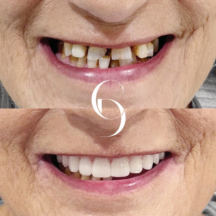 All Teeth on Implants