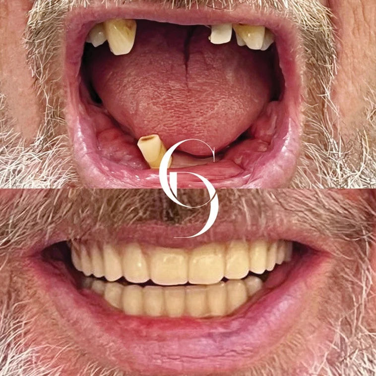 All Teeth on Implants