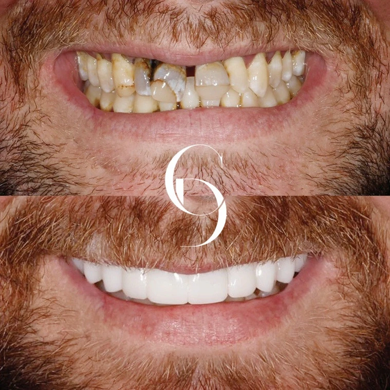 Dental Implant Hornsby