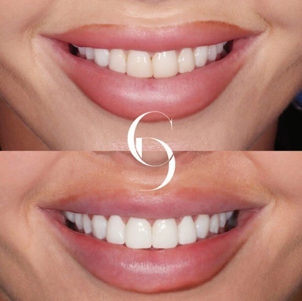 Dental Veneers