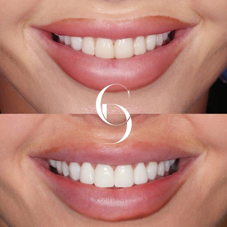 Dental Veneers