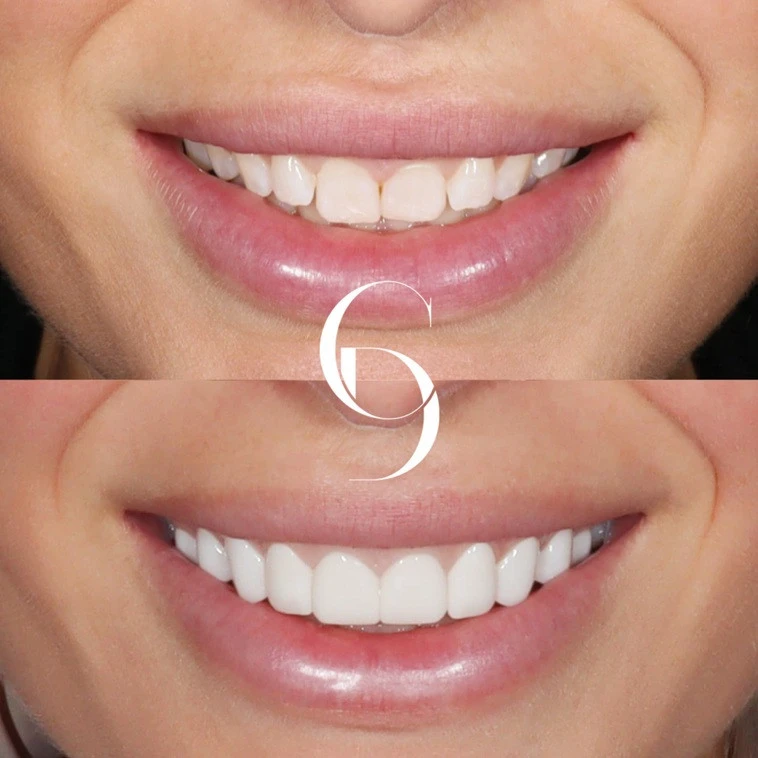 Dental Veneers