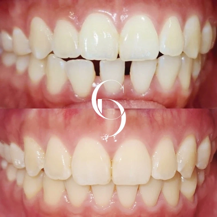 Invisalign