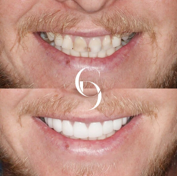 Porcelain Veneers