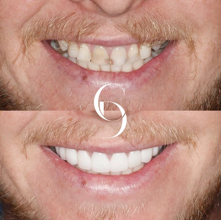 Porcelain Veneers