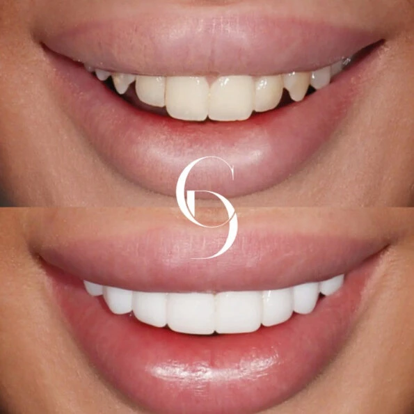 Porcelain Veneers