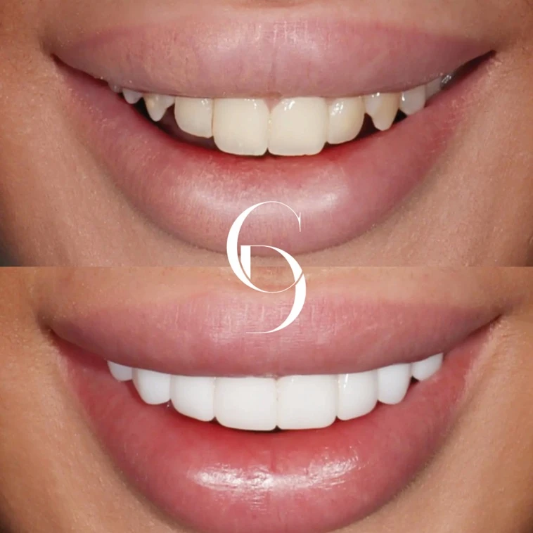 Porcelain Veneers