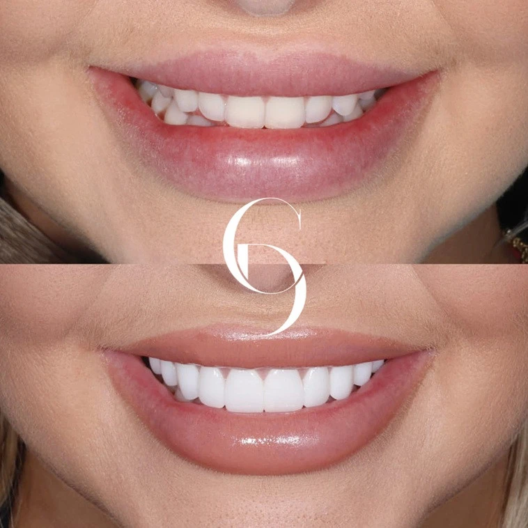 Porcelain Veneers