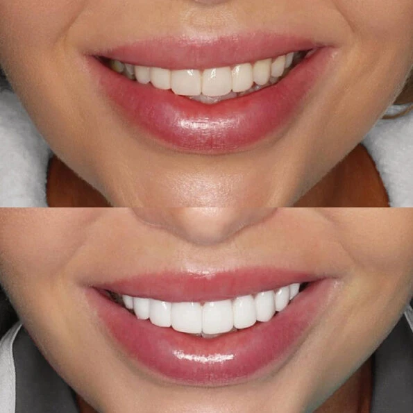 Teeth Veneers