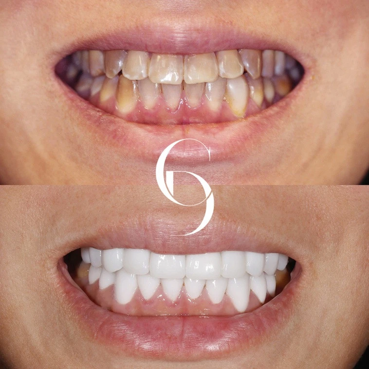Teeth Veneers