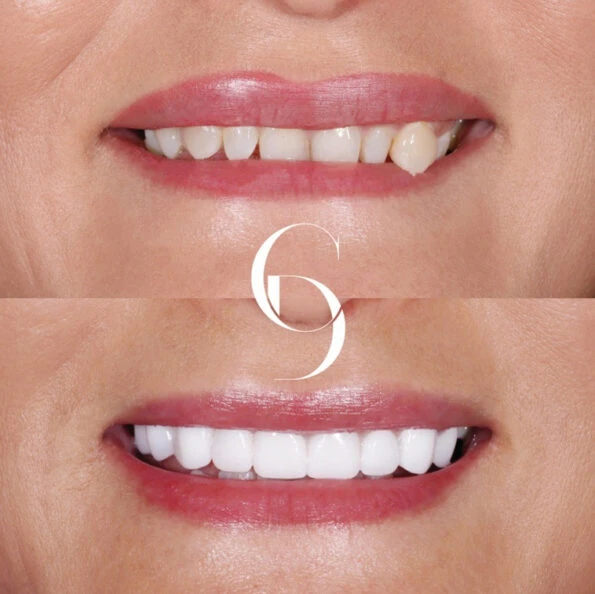 Smile Makeover