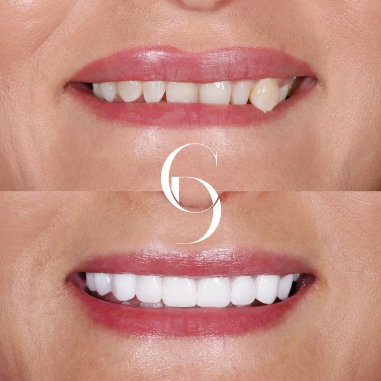 Smile Makeover