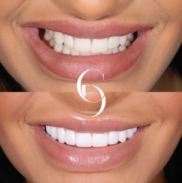 Smile Transformation