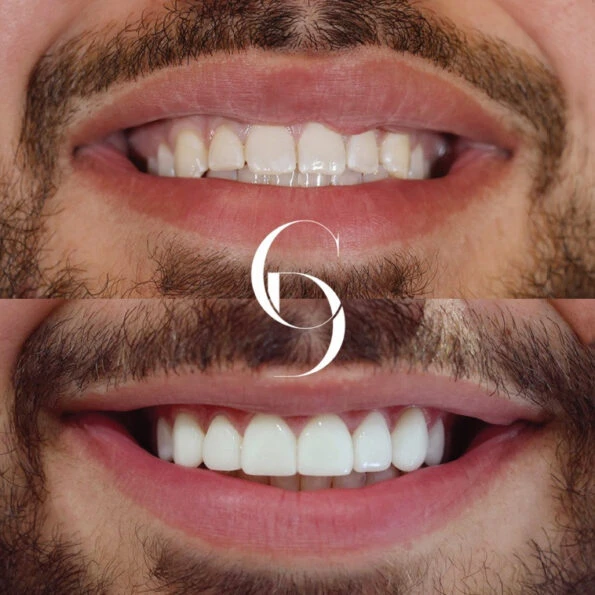 Smile Transformation