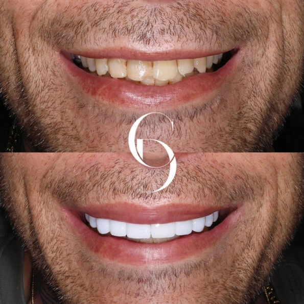 Smile Transformation